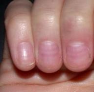 Основные болезни ногтей на руках и методы их лечения