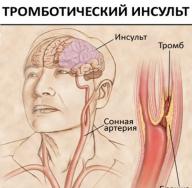 ما هي السكتة الدماغية السكتة الدماغية في علاج تجمع ZMA